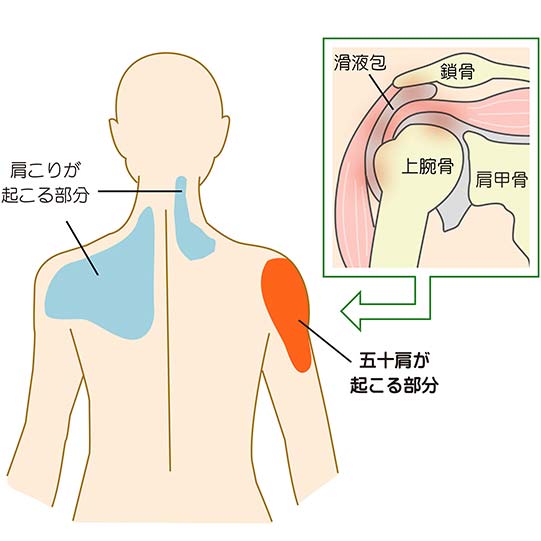 手 を つく と 肩 が 痛い